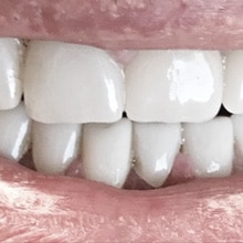 Full Mouth Makeovers in Texas, Pflugerville, San Antonio, San Marcos, and Garland, Simply Crowns Dental Implant Crown and Bridges, Dental Bridge in Pflugerville, San Antonio, San Marcos, and Garland Dr. Poest, Dr. Bhakta, Dr. Talebloo