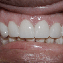 Full Mouth Makeovers in Texas, Pflugerville, San Antonio, San Marcos, and Garland, Simply Crowns Dental Implant Crown and Bridges, Dental Bridge in Pflugerville, San Antonio, San Marcos, and Garland Dr. Poest, Dr. Bhakta, Dr. Talebloo